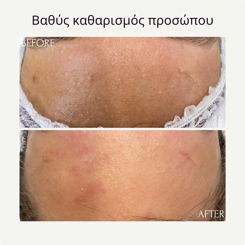 Βαθύς καθαρισμός προσώπου