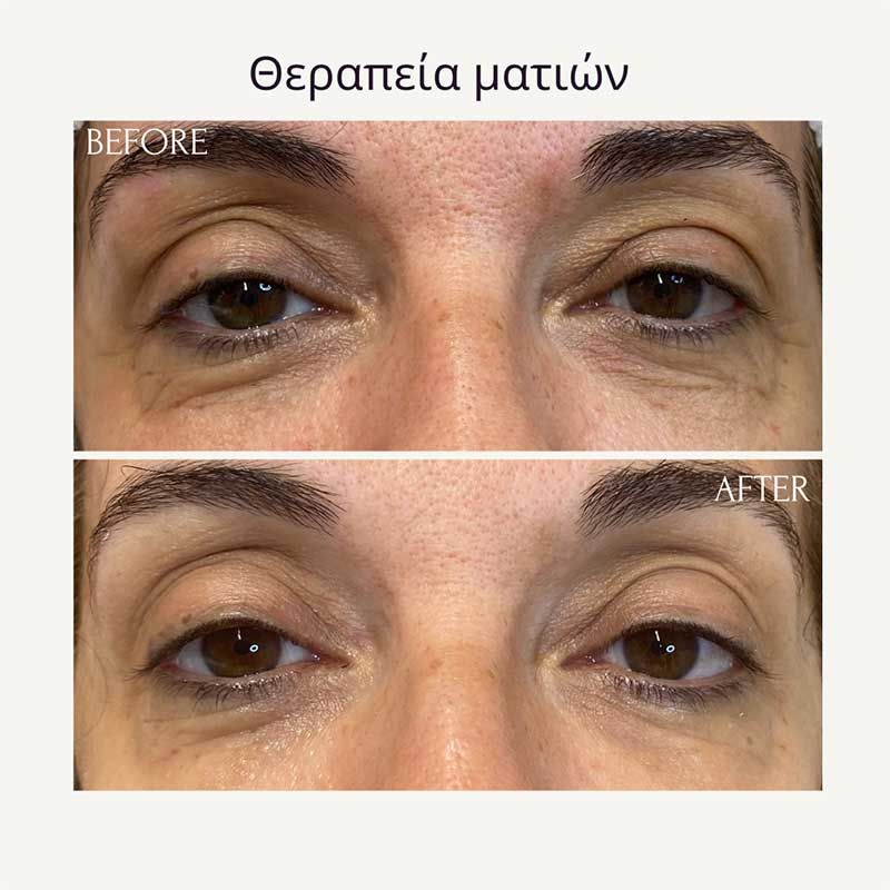 Θεραπεία ματιών