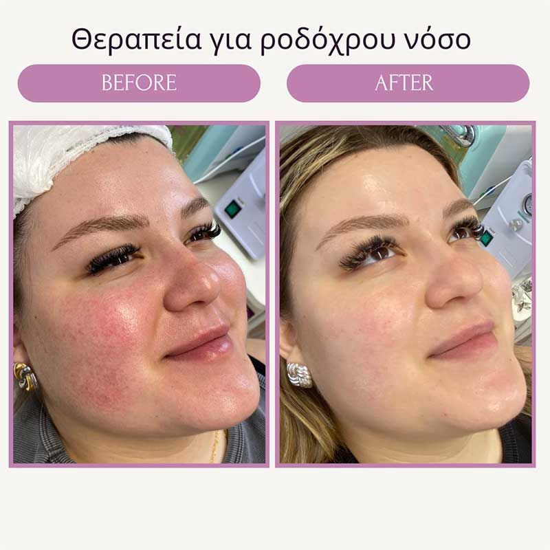 Θεραπεία για ροδόχρου νόσο