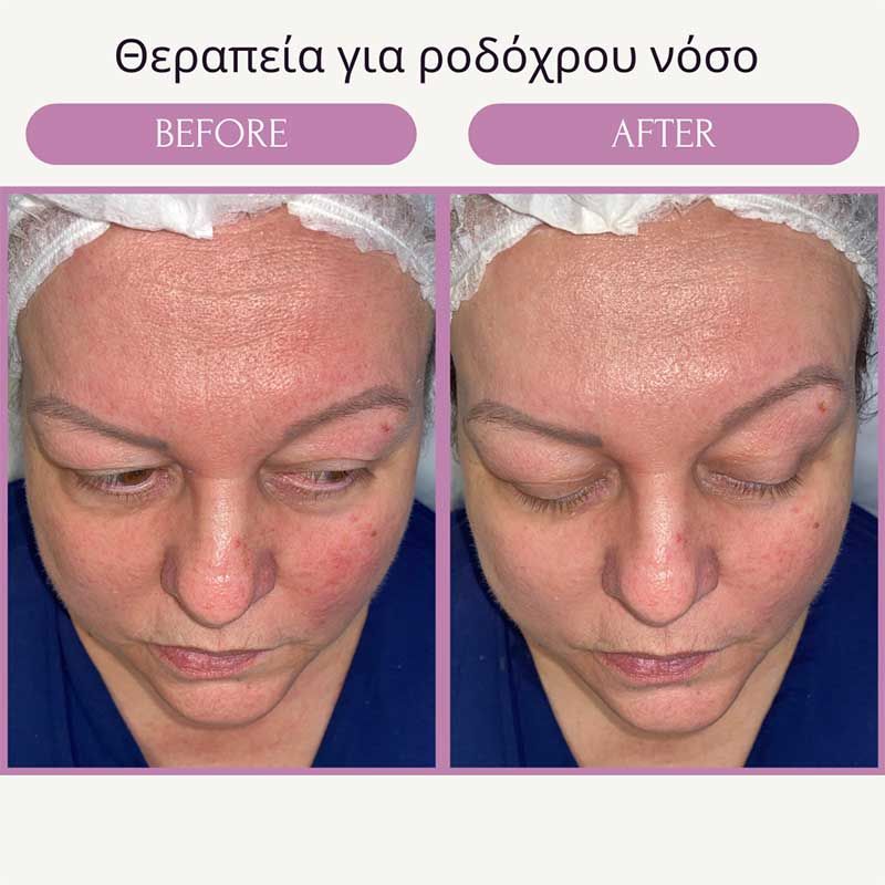 Θεραπεία για ροδόχρου νόσο