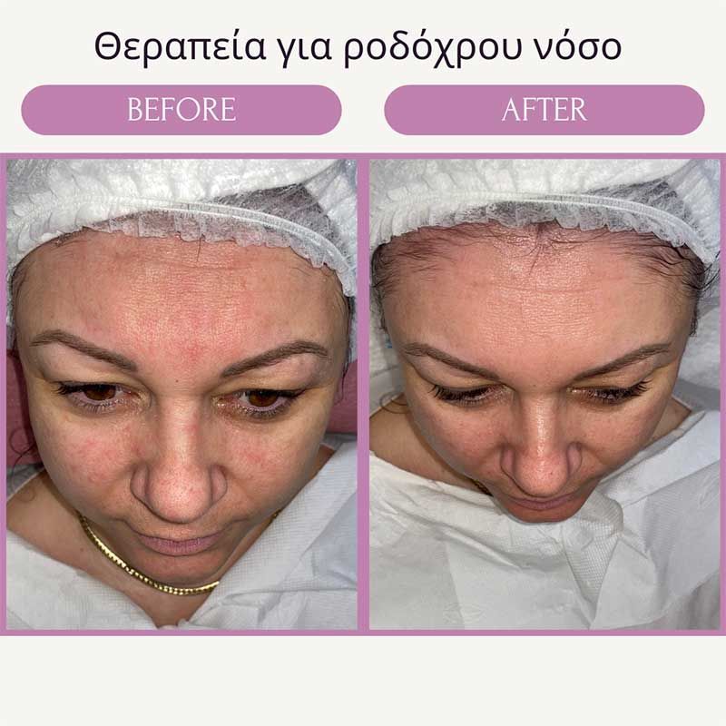 Θεραπεία για ροδόχρου νόσο