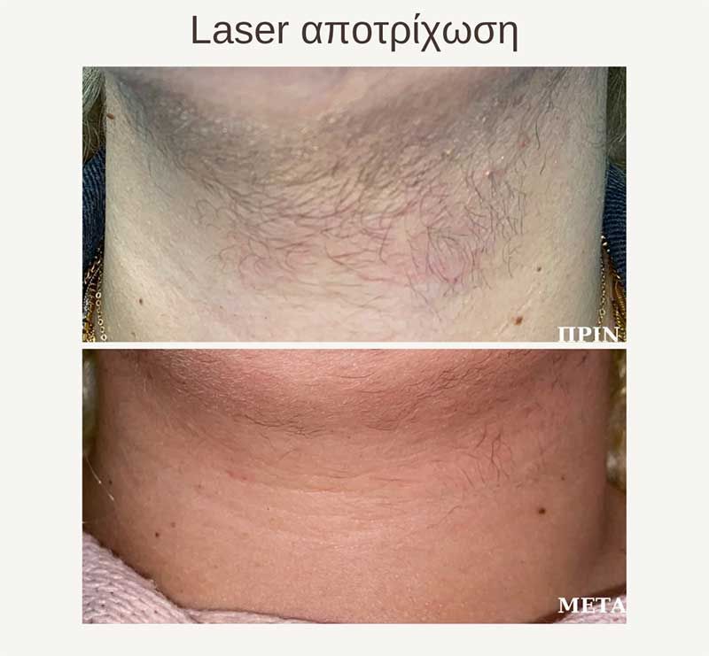 Laser αποτρίχωση