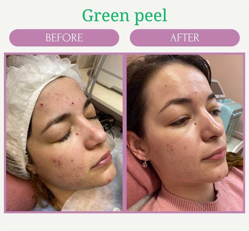 Green Peel