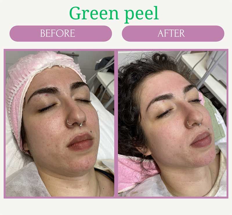 Green Peel