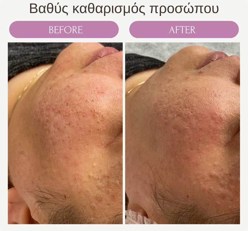 Βαθύς καθαρισμός προσώπου