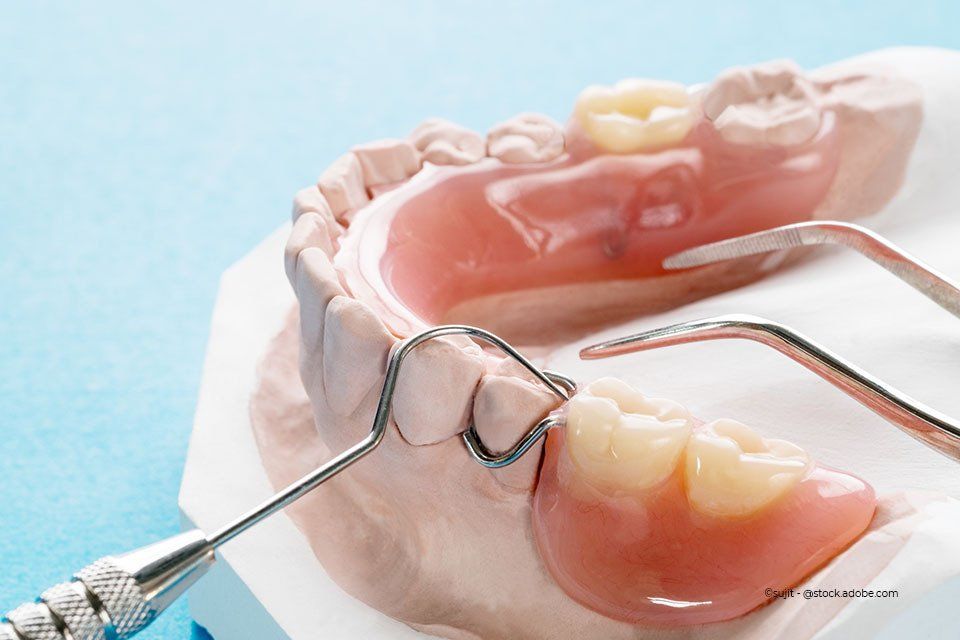 Modellabguss eines Gebisses, hergestellt von der Zahnkult GmbH