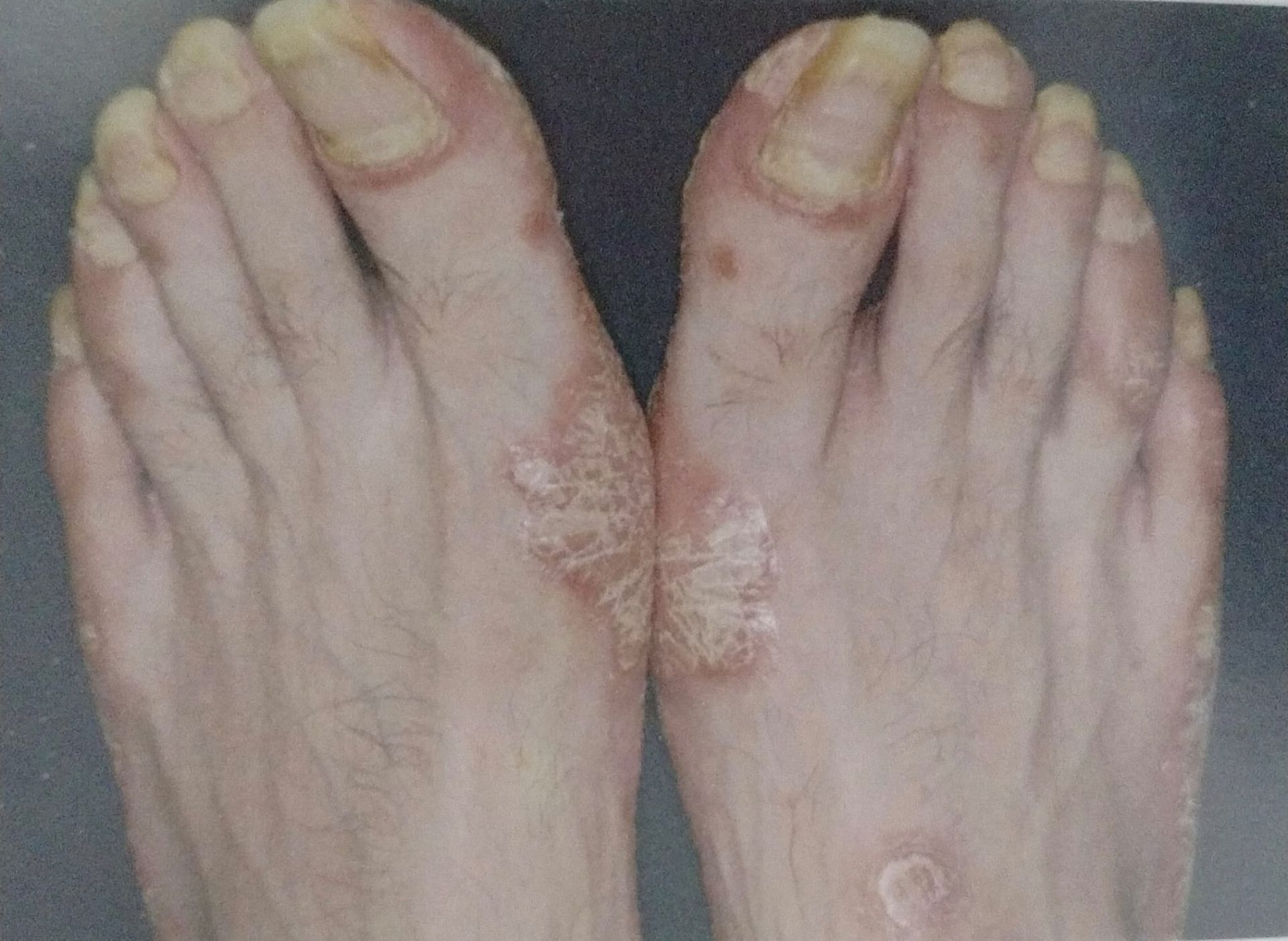 Pies con uñas amarillentas y engrosadas y manchas escamosas en la piel.