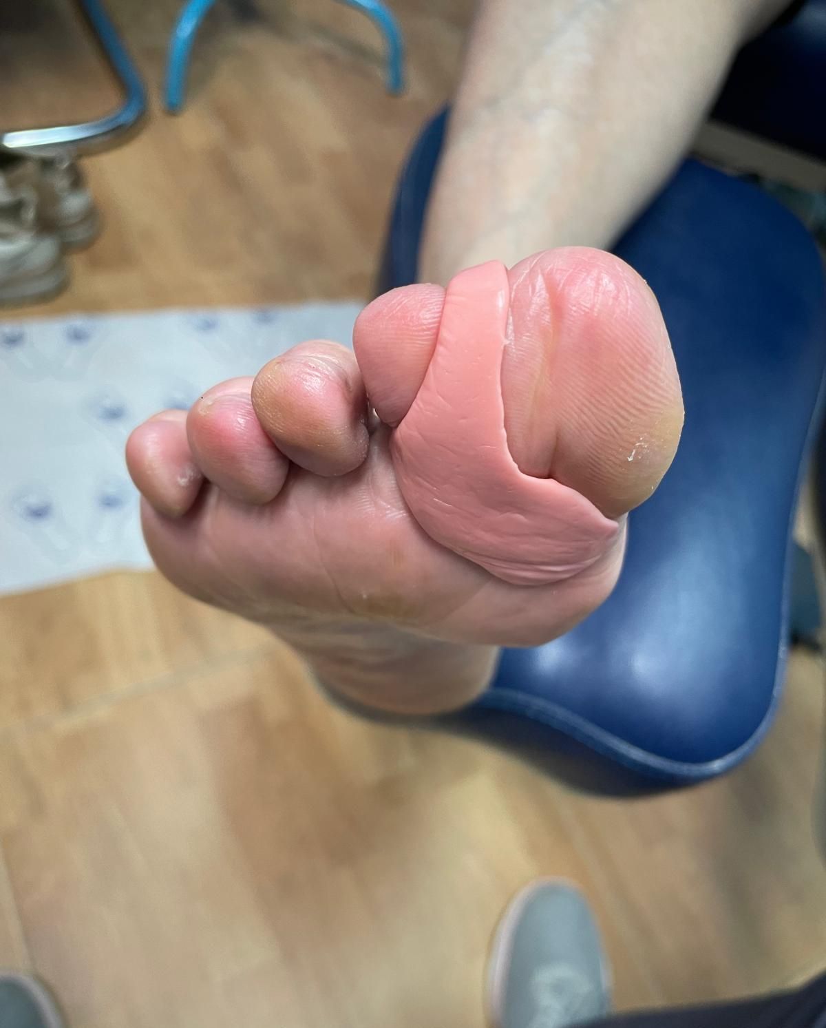 Pie con almohadilla rosada en el dedo gordo, en un entorno médico, posiblemente durante un tratamiento.