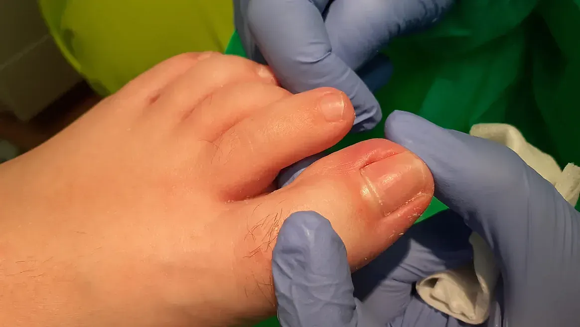 El dedo del pie de una persona siendo examinado por manos con guantes azules, posiblemente para un procedimiento médico.