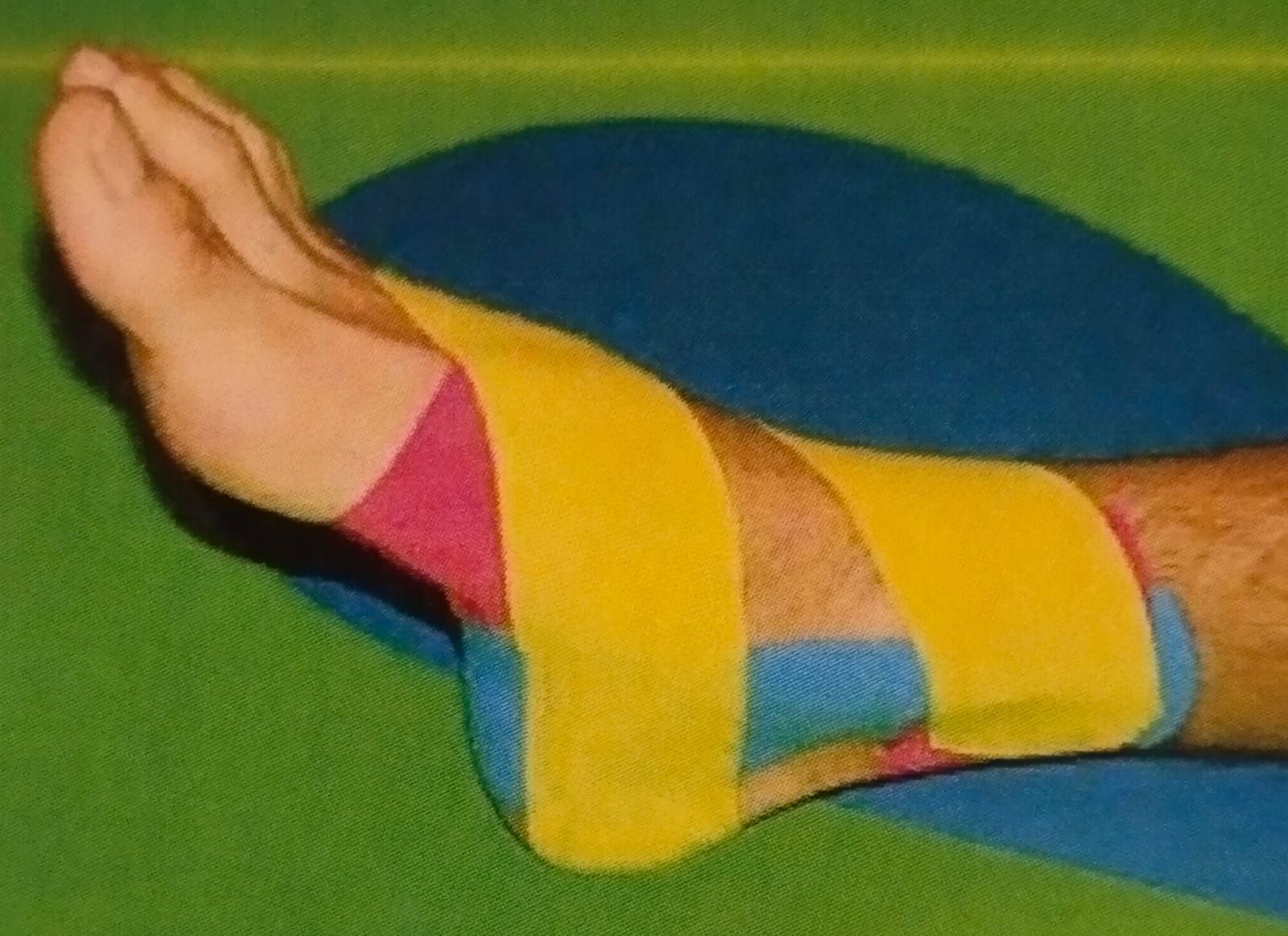 Pie con cinta kinesiológica amarilla, rosa y azul aplicada para brindar apoyo y aliviar el dolor.