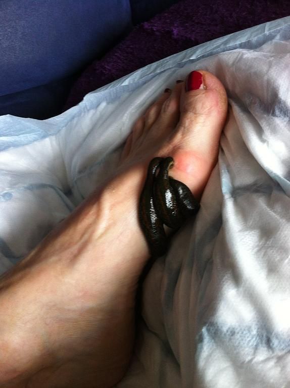 hirudothérapie - Mathieu Kägi - Vésenaz