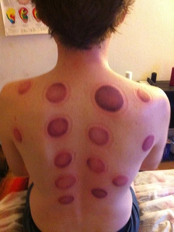 Mathieu Kaegi - thérapie par ventouses - Vésenaz