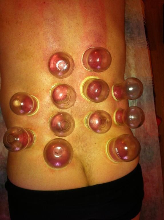 Mathieu Kaegi - thérapie par ventouses - Vésenaz