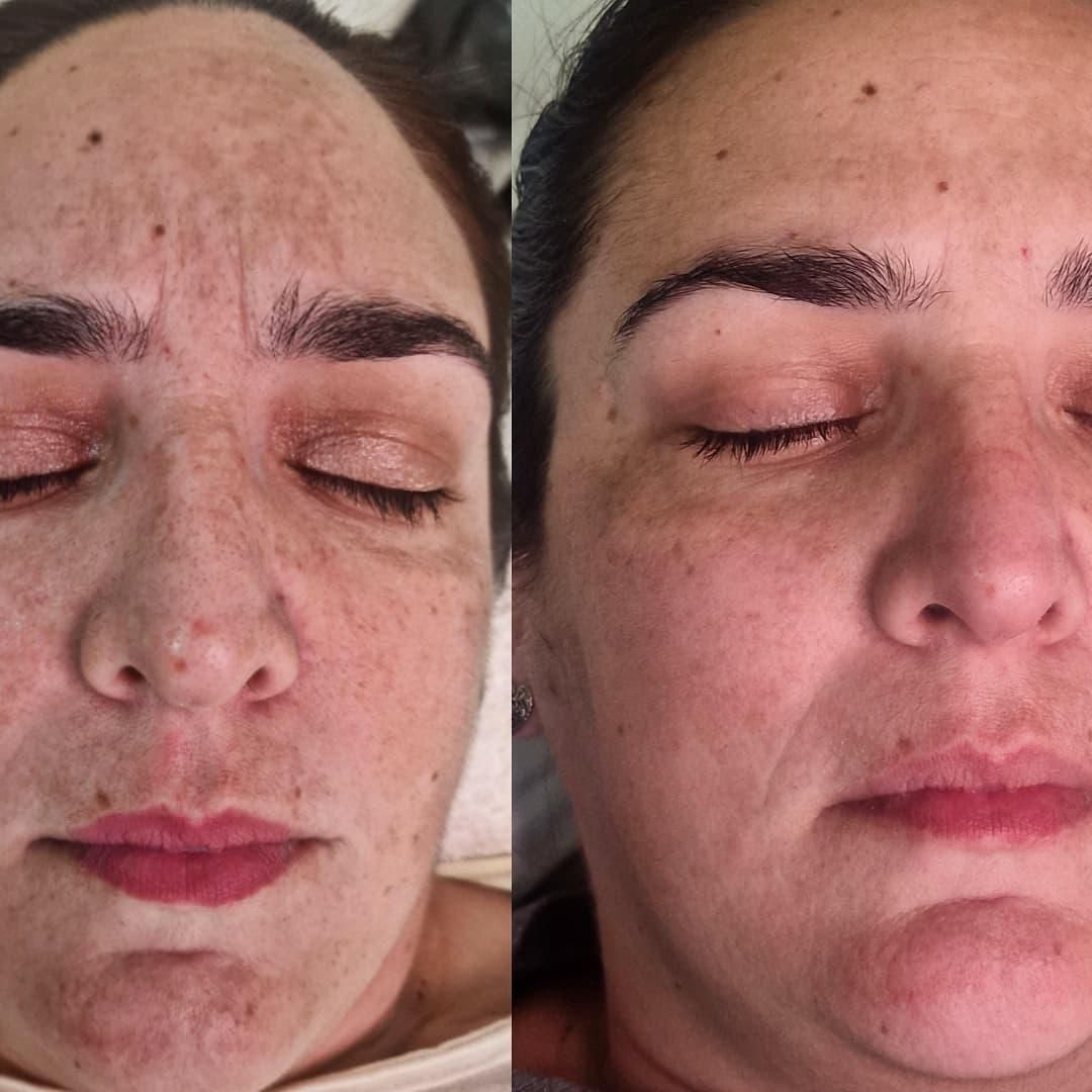 Comparación lado a lado del rostro de una persona. A la izquierda se muestran manchas y arrugas.