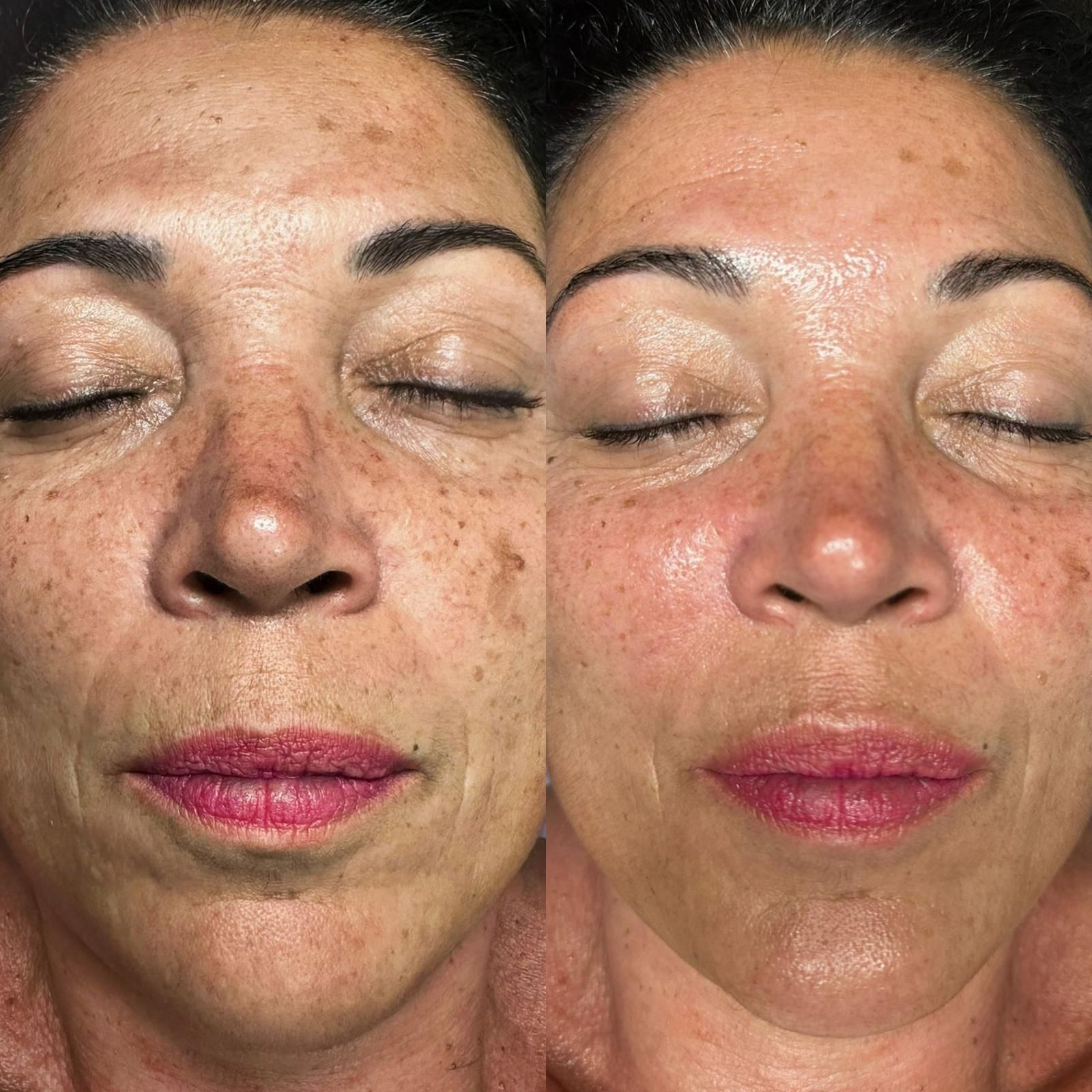 Antes y después del tratamiento facial: se observa una reducción de las manchas solares y una mejora del tono de la piel.
