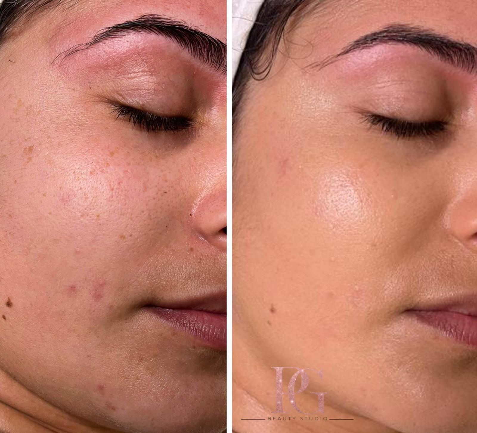 Comparación lado a lado del rostro de una persona. Lado izquierdo: piel con imperfecciones. Lado derecho: piel más tersa 