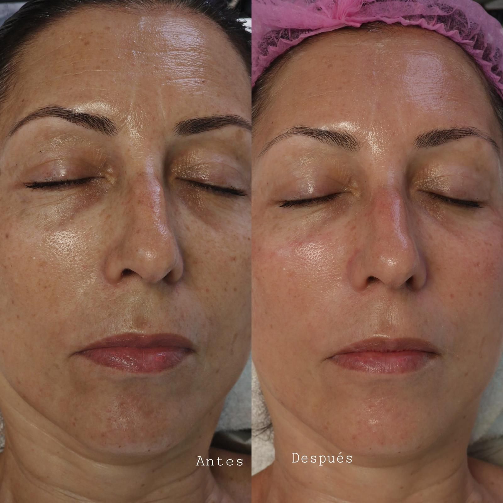 Comparación del rostro de una persona antes y después del tratamiento, reduciendo la hiperpigmentación y mejorando