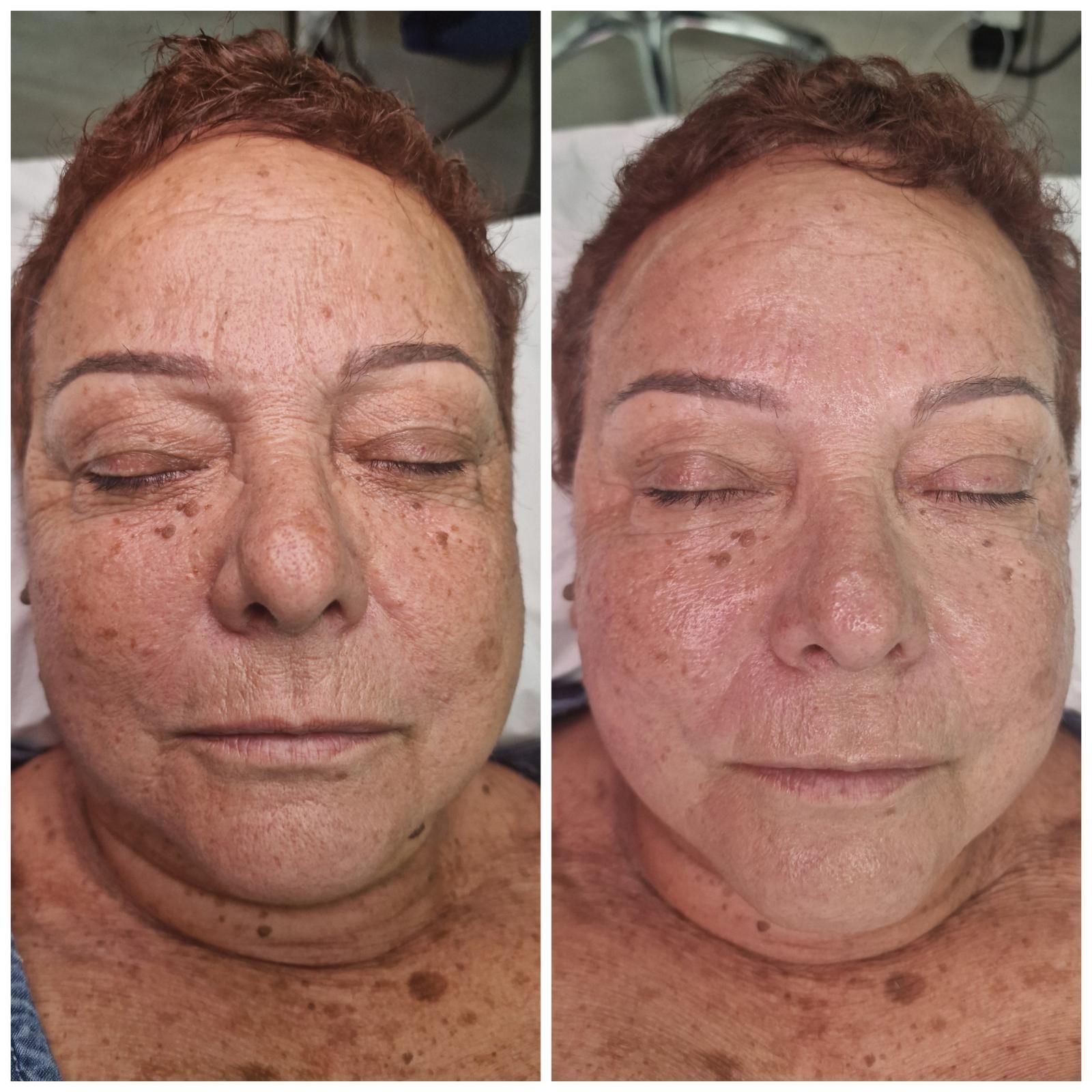 Fotos del rostro de una persona antes y después; la piel aparece más clara, con una menor decoloración.