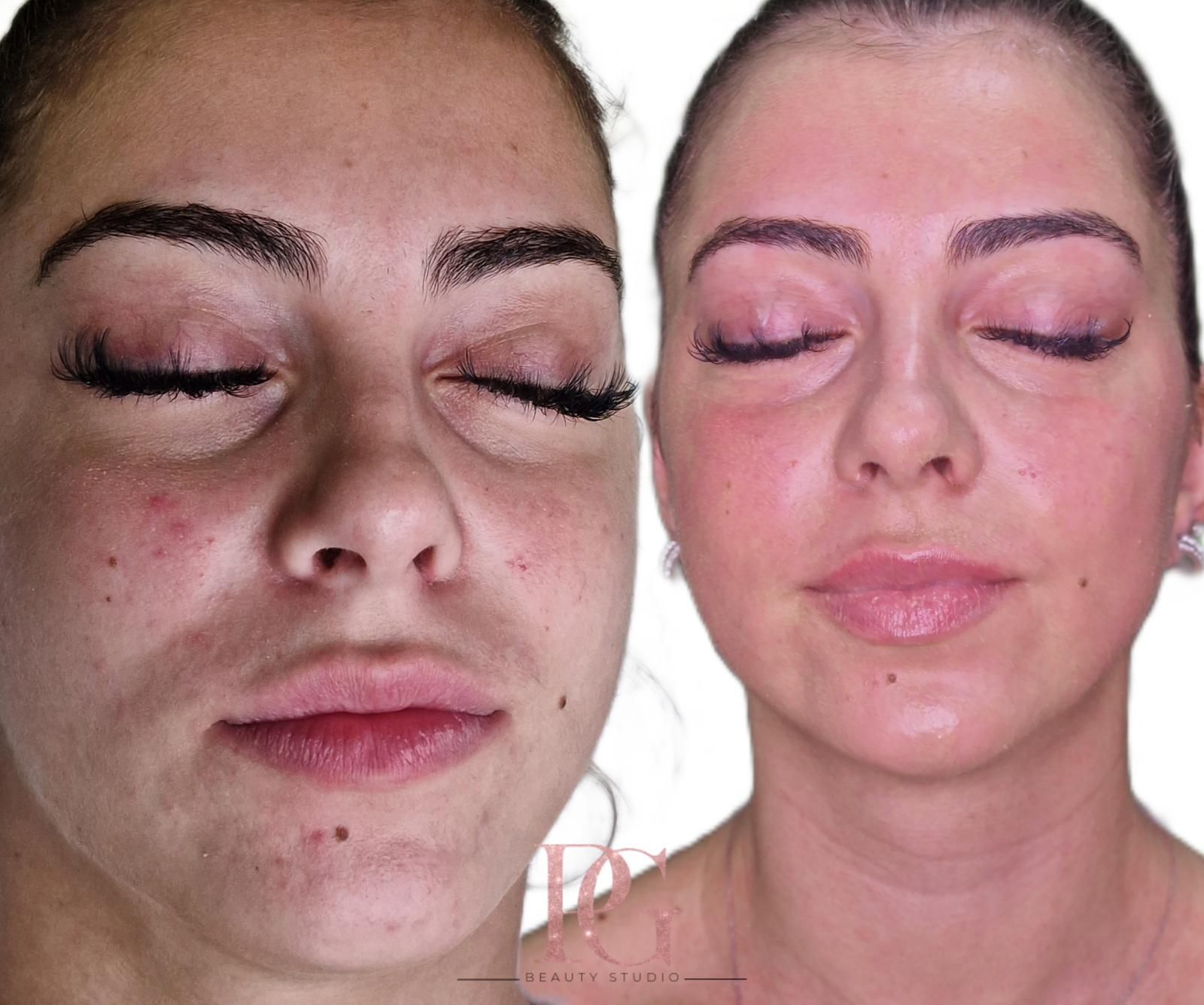 Tratamiento facial antes y después; mujer con los ojos cerrados, reducción del enrojecimiento de la piel, tez más suave.