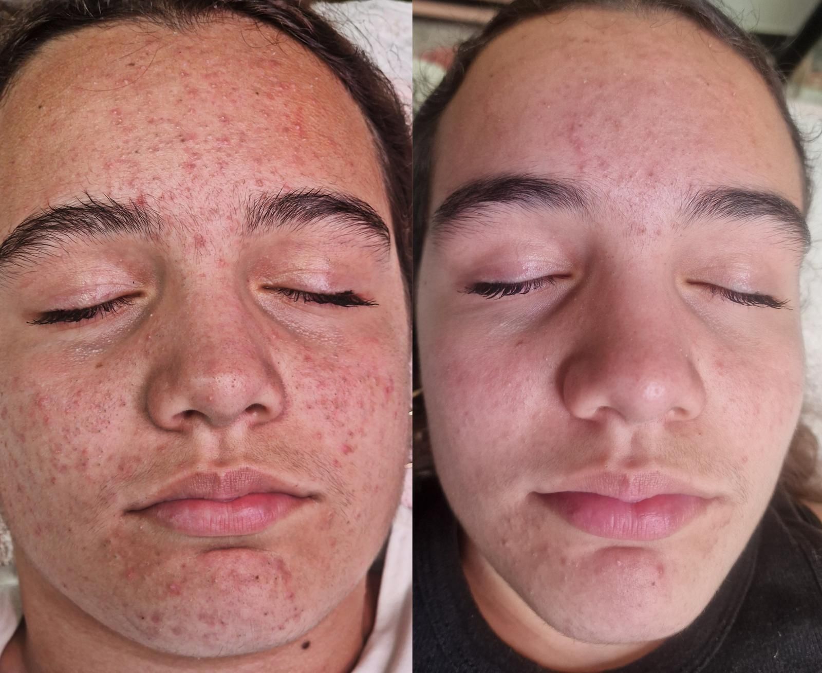 Comparación del rostro de una persona antes y después. Lado izquierdo: acné. Lado derecho: piel sin acné.