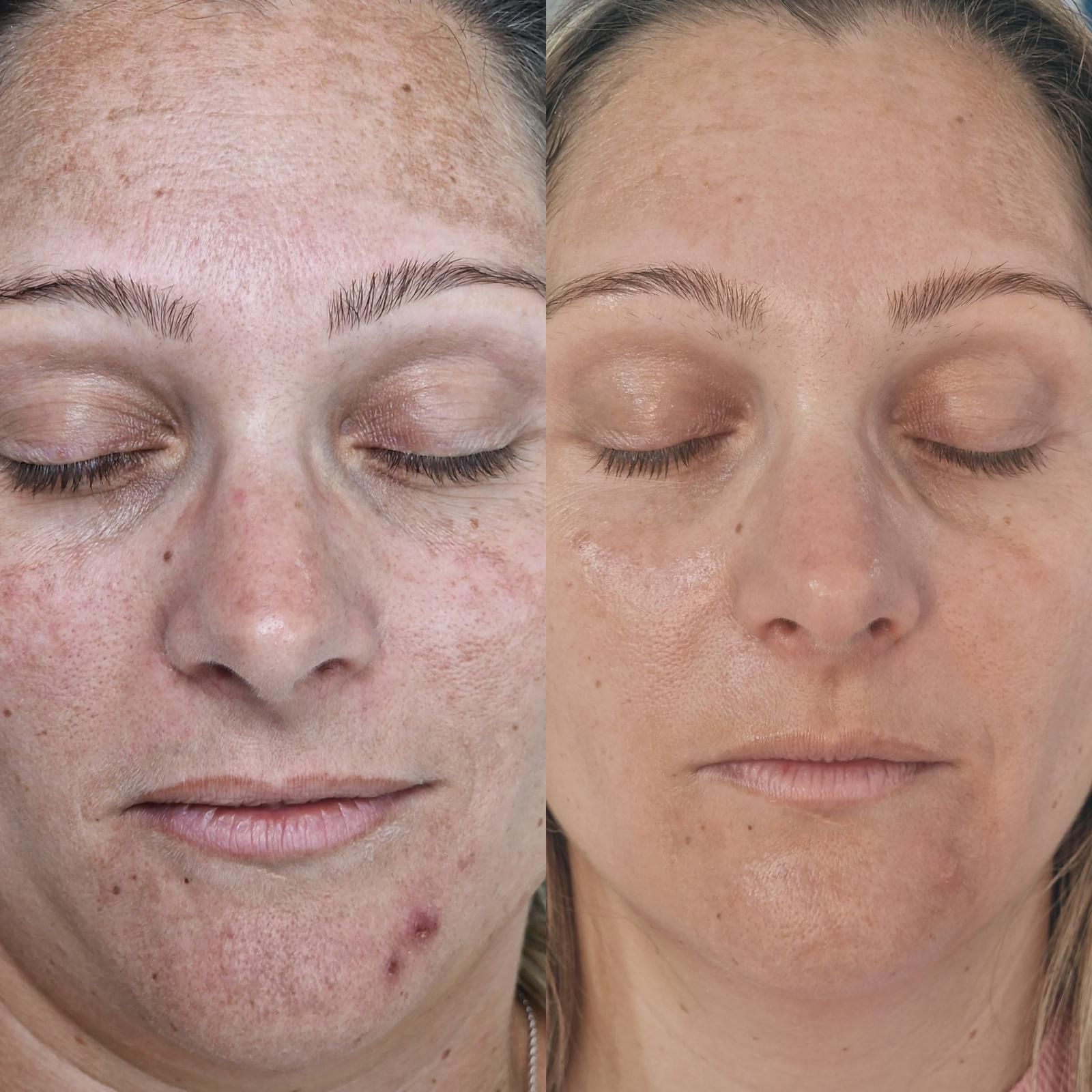 Comparación lado a lado del rostro de una persona. A la izquierda se muestra la piel con manchas oscuras