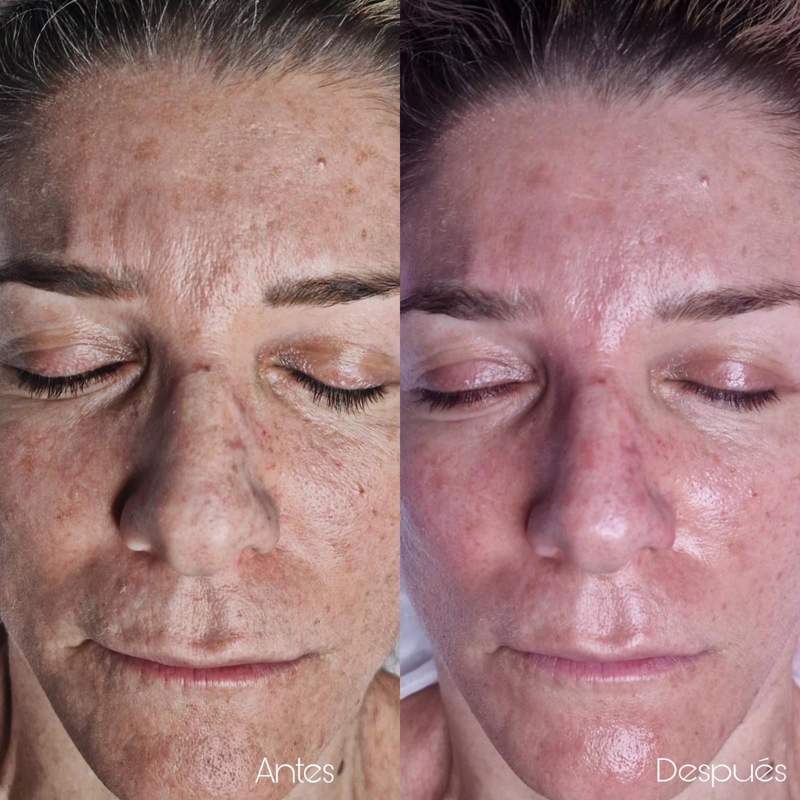 Comparación facial lado a lado. La imagen del antes muestra pecas y arrugas. La imagen del después muestra