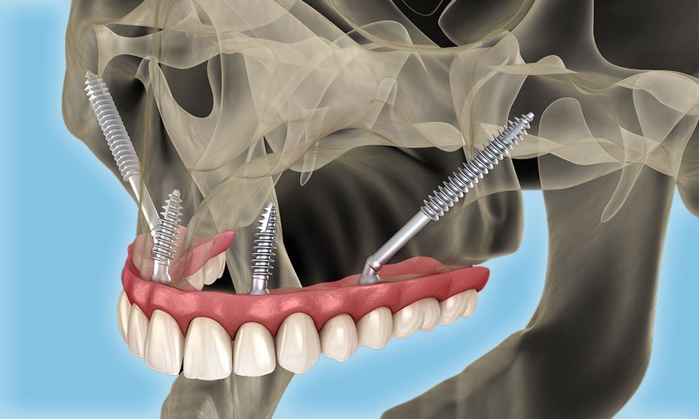 dental bridge – جسور الأسنان