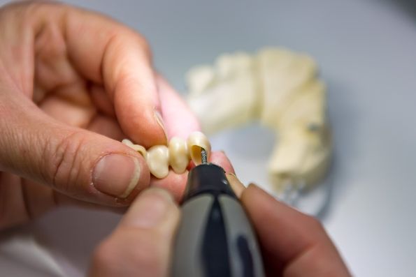Kronen, Brücken - dental technik claudia meier in Kriens