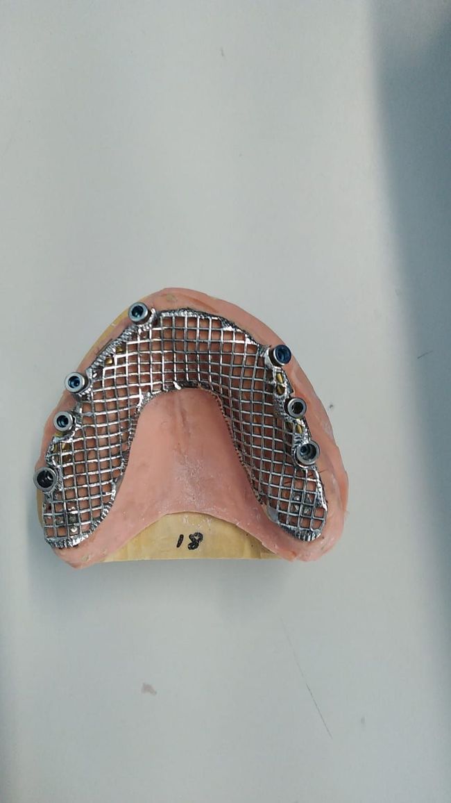 Un primer plano de un aparato dental sobre una superficie blanca.