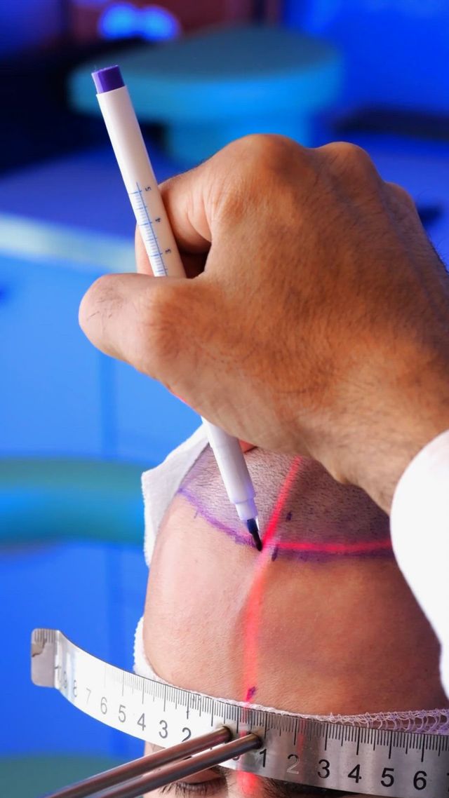 sthetische Medizin & Haartransplantation Hamburg