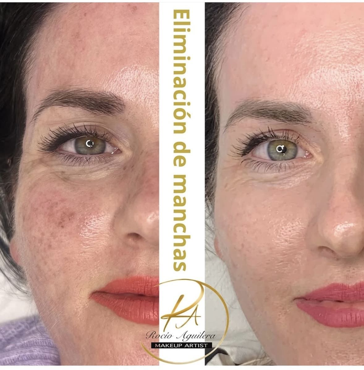 Fotografía de la piel del rostro antes y después que muestra una reducción de las manchas oscuras y una tez más suave, etiquetada como “Eliminación de manchas”.