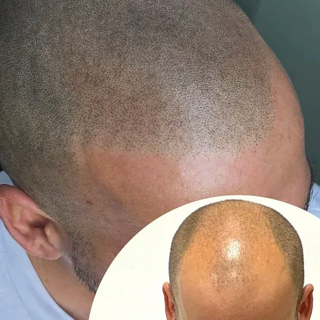 Un hombre con la cabeza rapada y una foto de su cabeza.