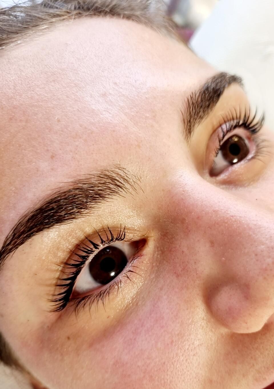 browlift