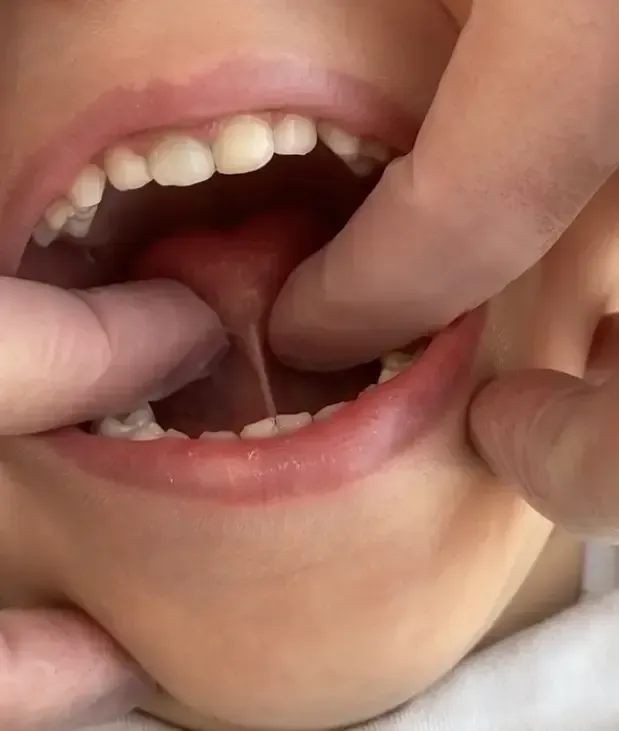Unas manos abren suavemente la boca del niño para mostrar los dientes y la lengua.
