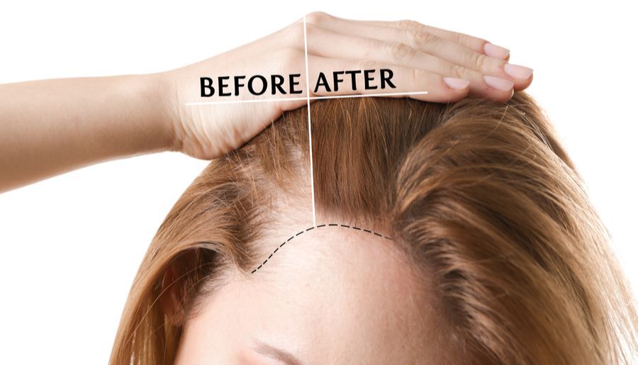 Se muestra el cabello de una mujer antes y después de un trasplante de cabello.