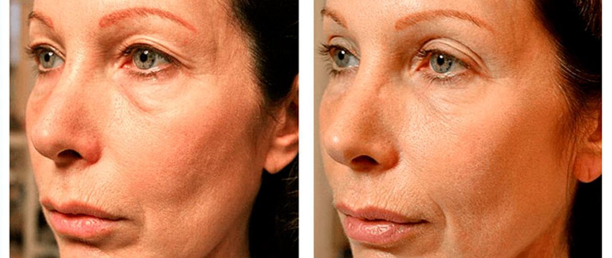 Una fotografía de antes y después del rostro de una mujer.