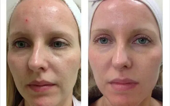 Una fotografía de antes y después del rostro de una mujer.