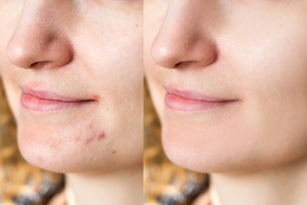 Una foto de antes y después de la cara de una mujer con acné.