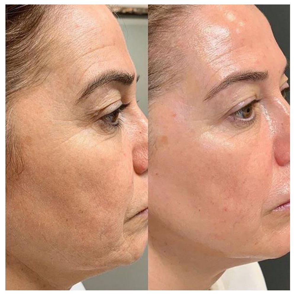 Una fotografía de antes y después del rostro de una mujer.