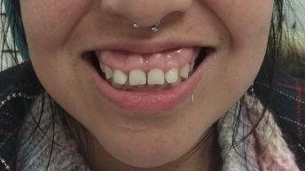 Primer plano de una persona sonriendo, mostrando los dientes y un piercing en el tabique.