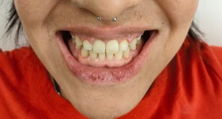 Primer plano de la boca sonriente de una persona que muestra dientes amarillentos, un piercing en el labio y viste una camisa roja.