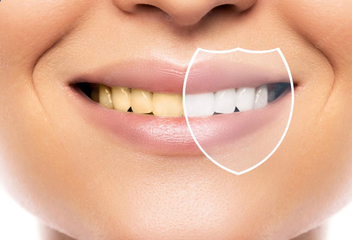 Dientes de una persona sonriente antes y después del tratamiento de blanqueamiento, con un gráfico de escudo sobre los dientes más blancos.