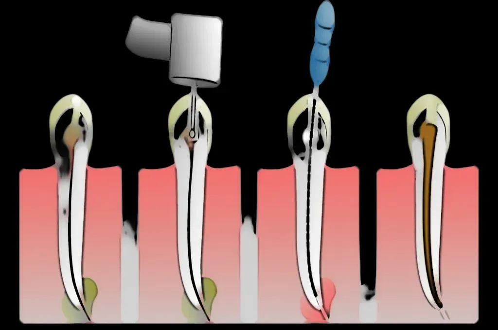 Diagrama de un diente sometido a tratamiento de conducto radicular; muestra las etapas de limpieza, relleno y sellado del conducto radicular.