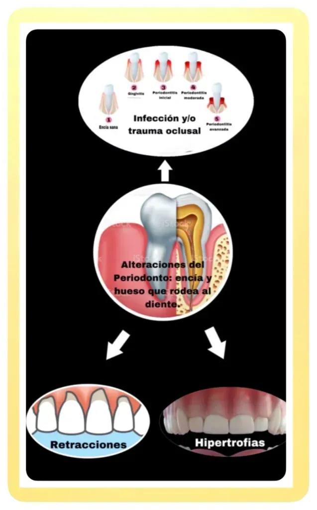 Diagrama que ilustra las etapas de la enfermedad periodontal, mostrando cambios en las encías y los huesos.