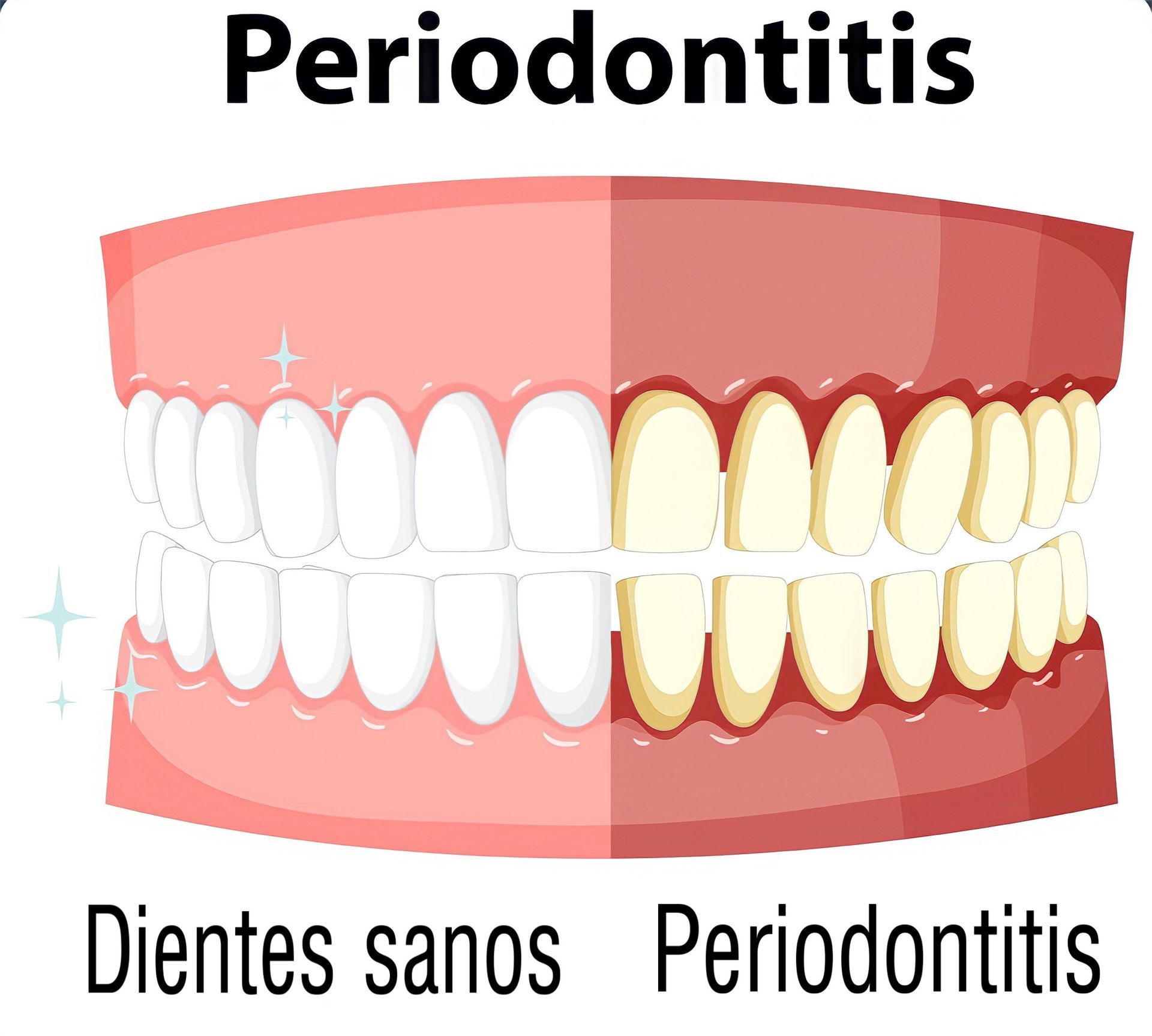Comparación: dientes sanos (izquierda) vs. periodontitis (derecha), mostrando la diferencia de color.