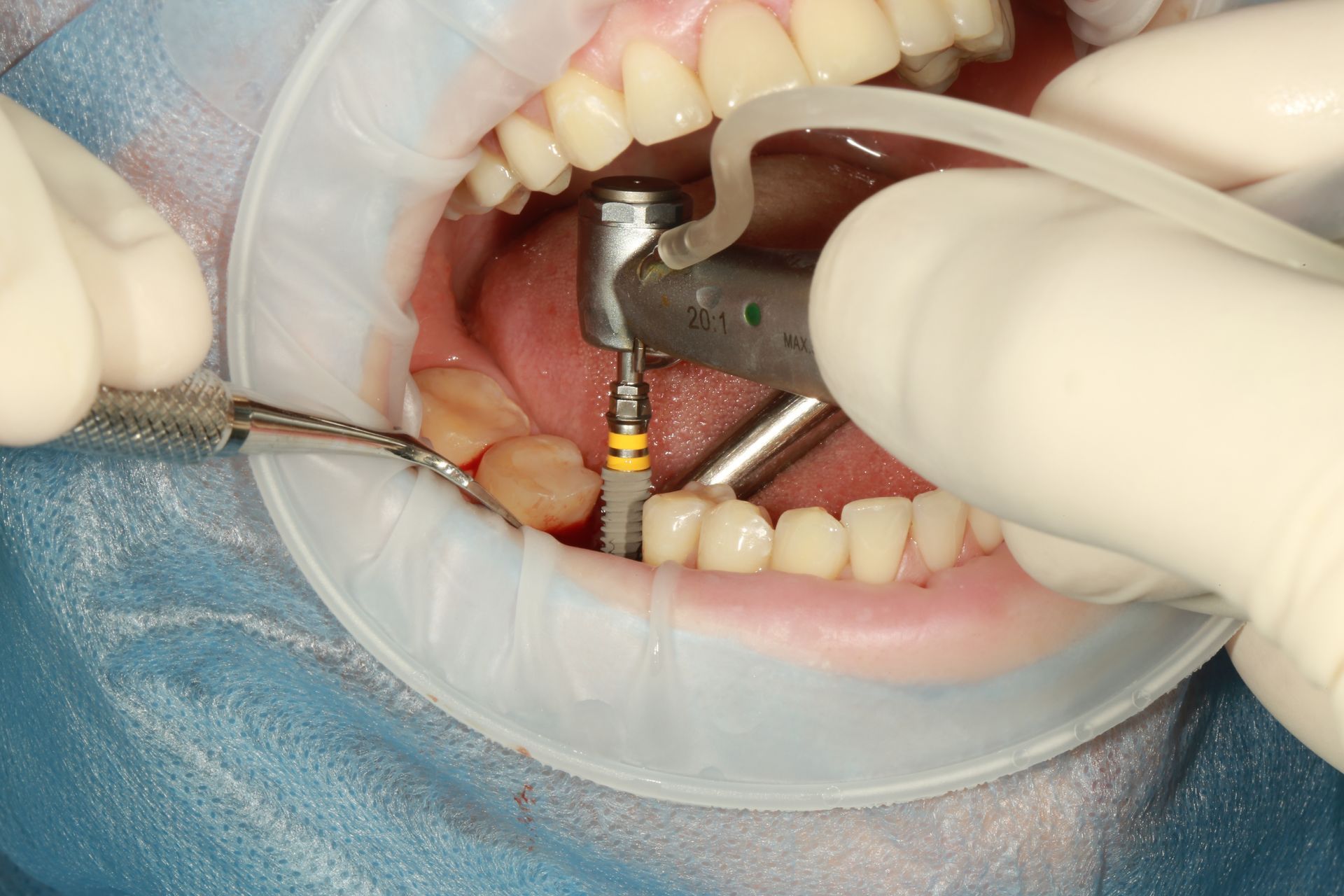Procedimiento dental: Mantener la boca abierta con un retractor de mejillas y un taladro en uso.