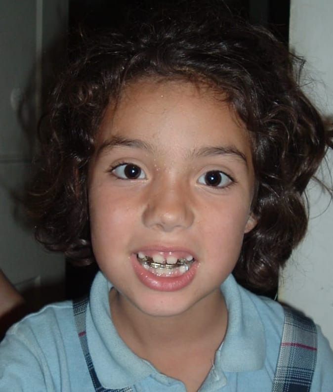 Niño con brackets sonriendo, vistiendo una camisa azul.