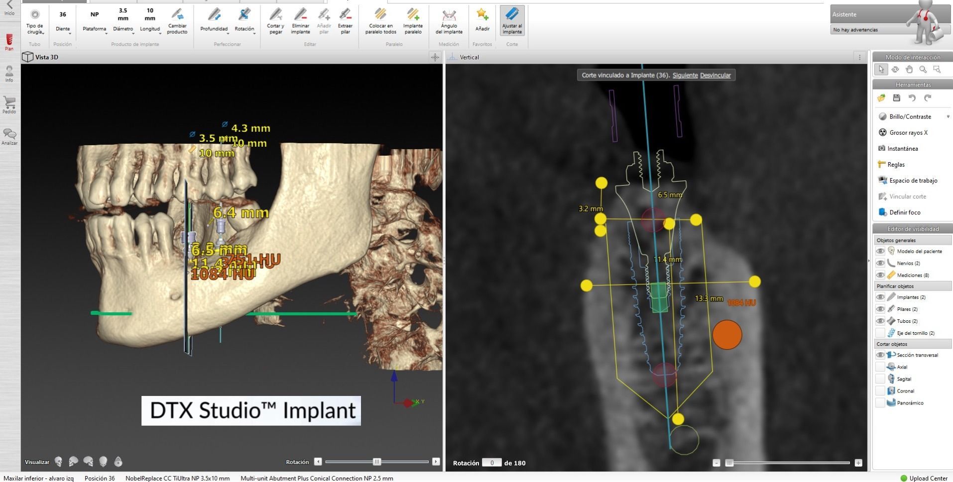 Interfaz de software de planificación de implantes dentales; modelo de mandíbula 3D y vista de sección transversal, con guías y marcadores.