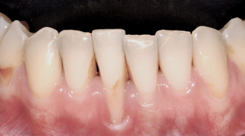 Primer plano de dientes con decoloración en un diente frontal y el tejido de las encías circundante.
