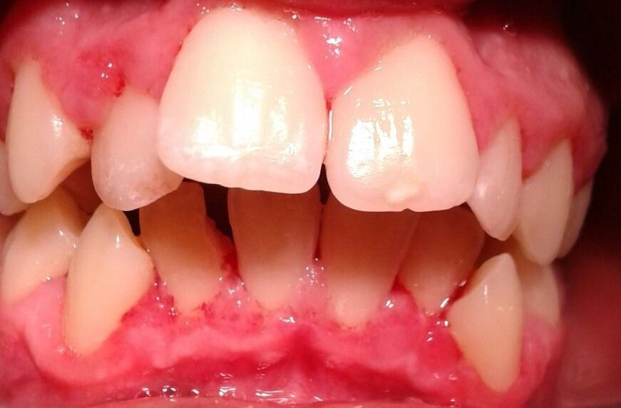 Vista de cerca de los dientes en una mordida alineada irregularmente, que muestra apiñamiento y espaciamiento desigual, contra encías rojas.